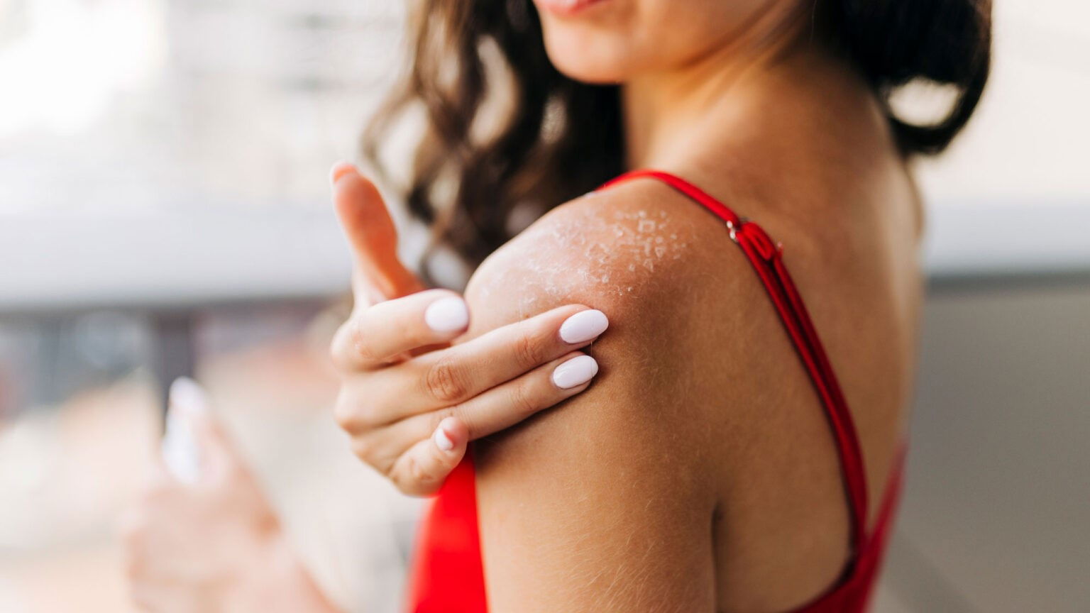 Mujer con quemadura solar