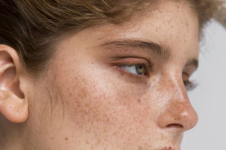 ¿Qué es el melasma y cómo tratarlo según una dermatóloga
