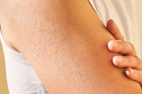 Queratosis pilar: lo que nadie te cuenta (y cómo puedes mejorarla desde hoy)